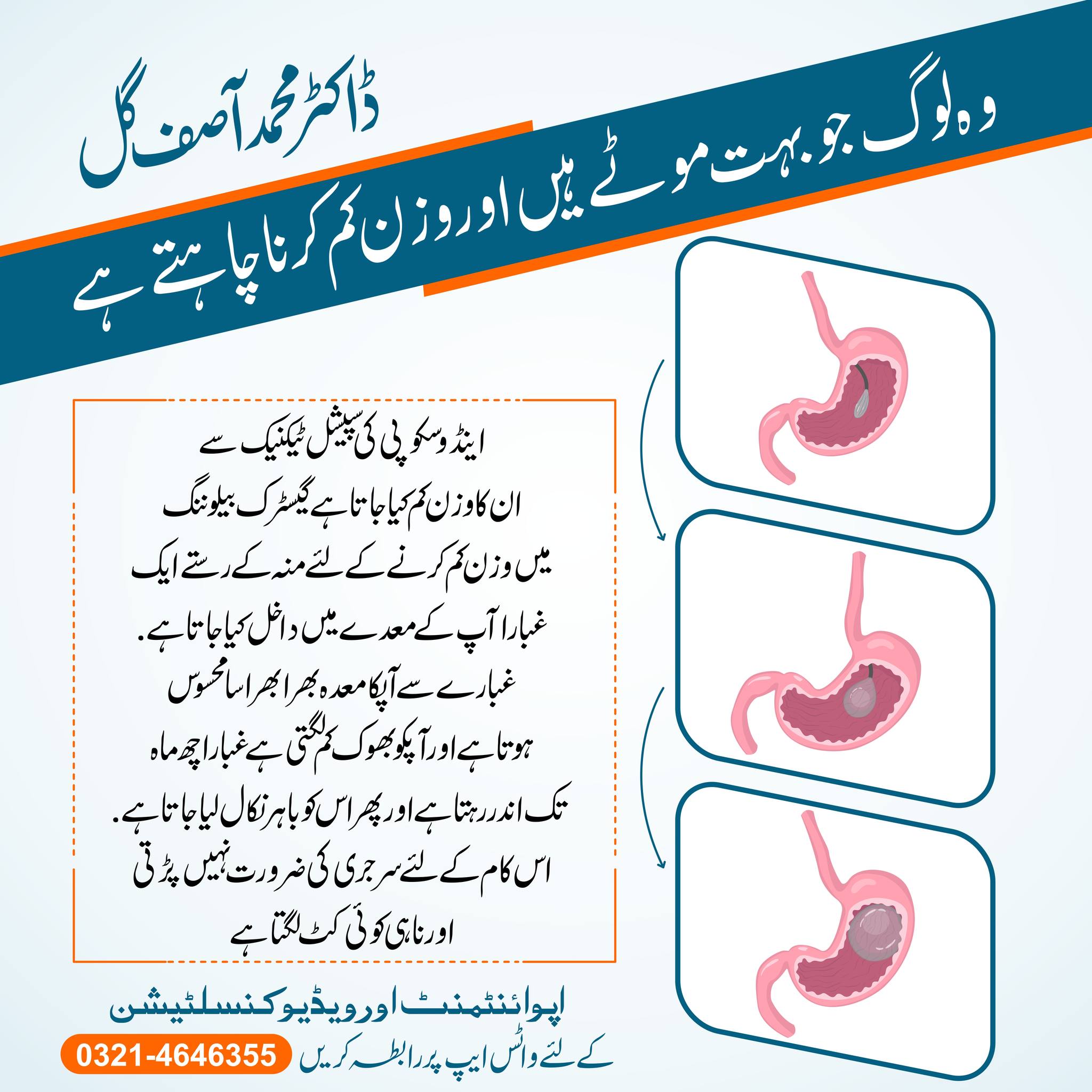 Gastric Ballooning Weight loss procedure